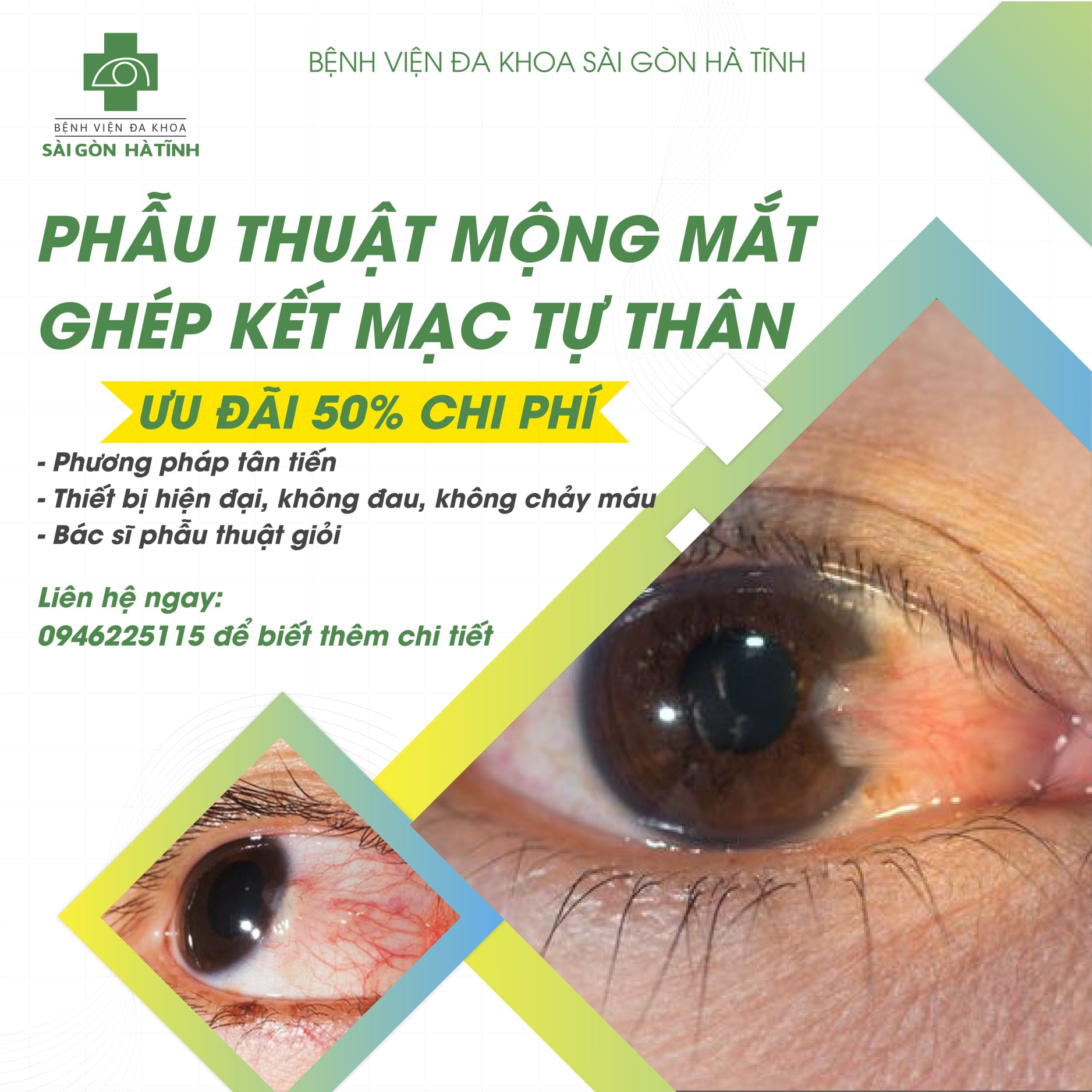 ƯU ĐÃI 50% CHI PHÍ PHẪU THUẬT MỘNG THỊT MẮT