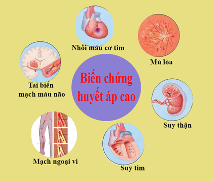 Tăng huyết áp - 'Kẻ giết người thầm lặng'