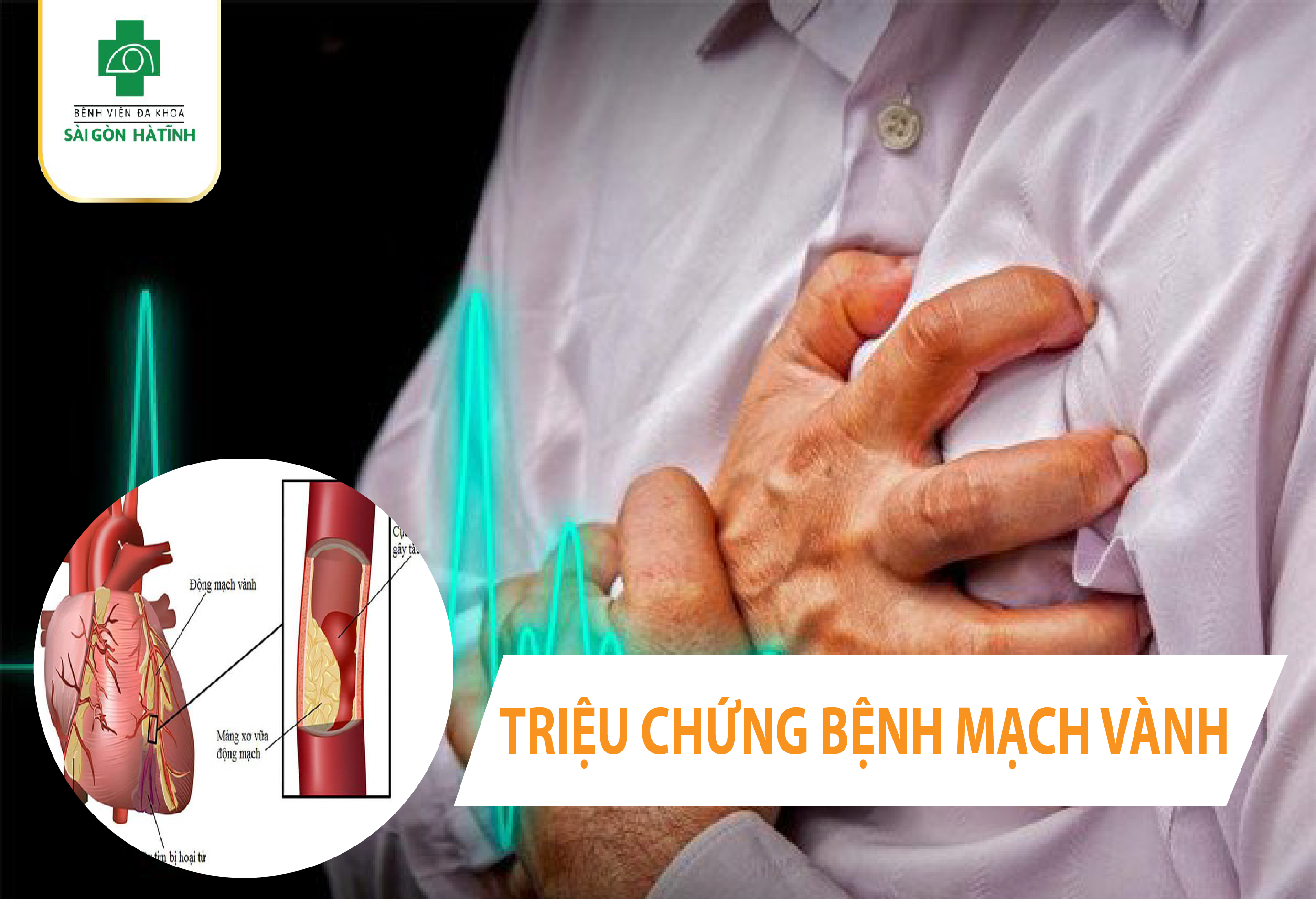 DẤU HIỆU CẢNH BÁO BỆNH MẠCH VÀNH 